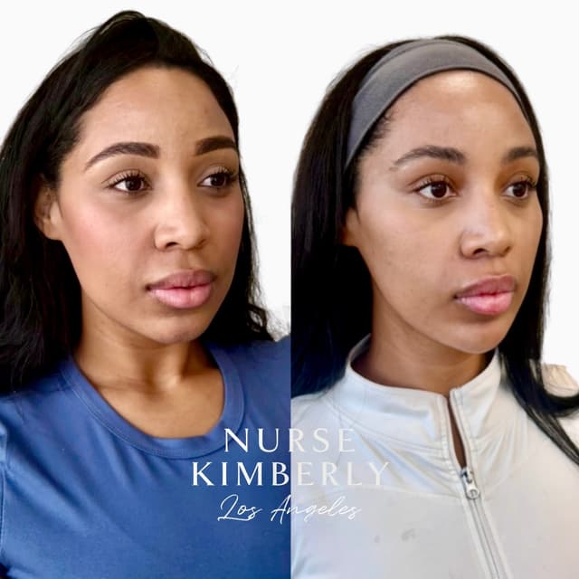 Full face filler rejuvenation results before and after