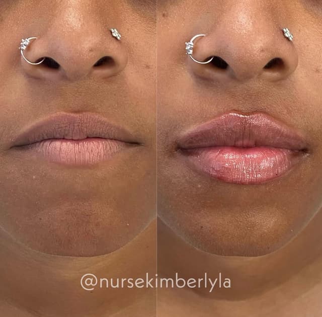 Lip filler injection before and after