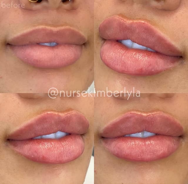 Lip filler injection before and after