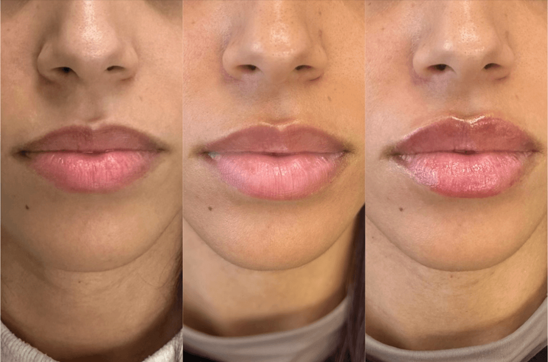 Lip filler injection before and after