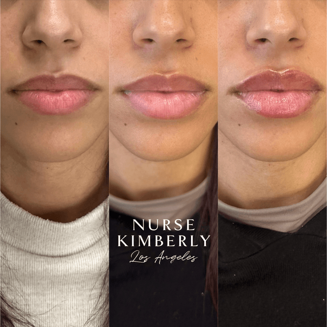 Lip filler injection before and after
