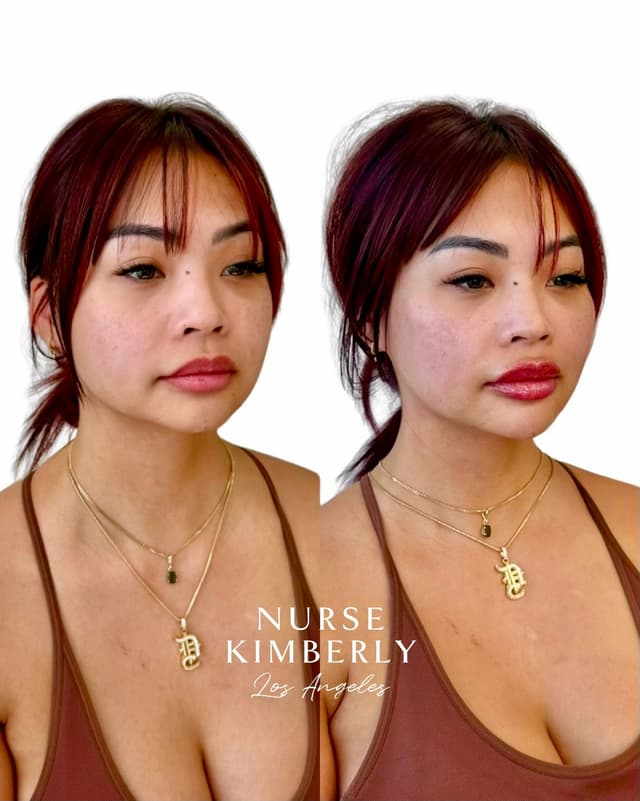 Filler results, natural youthful looking results