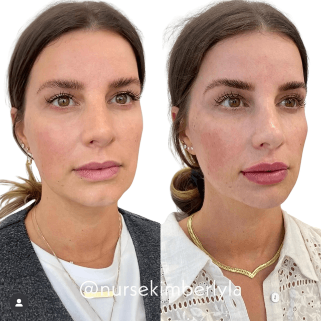Full face filler rejuvenation results before and after