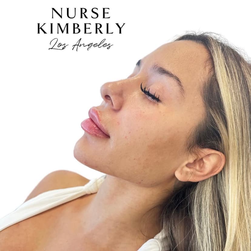 side profile jawline and chin filler before and after