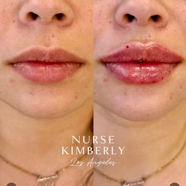 Lip filler before and after