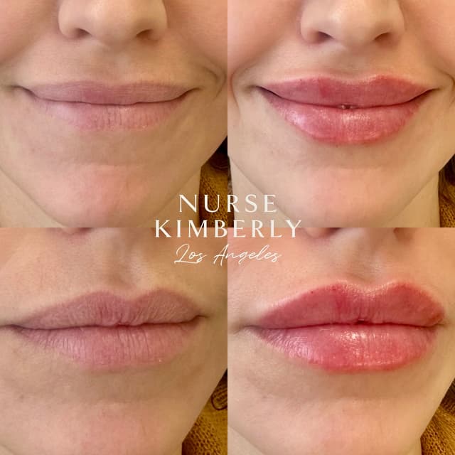 Lip filler injection before and after