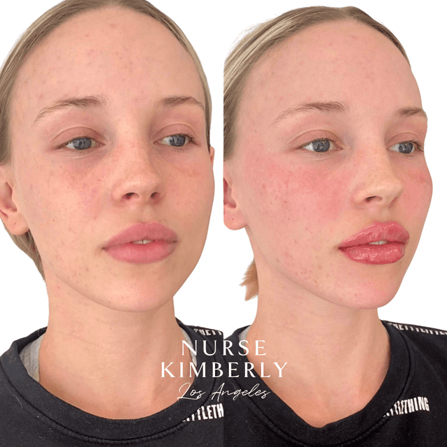 Full face filler rejuvenation results before and after