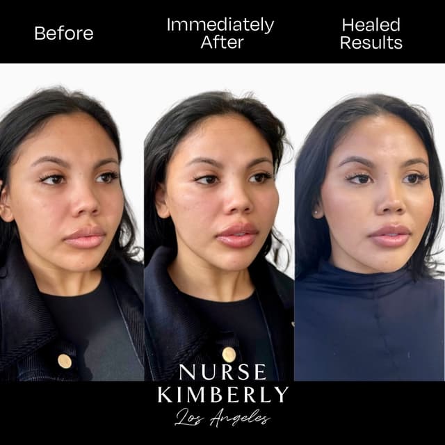filler results before, right after, and healed