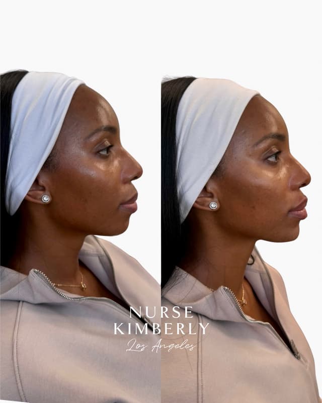 Jawline and chin filler before and after